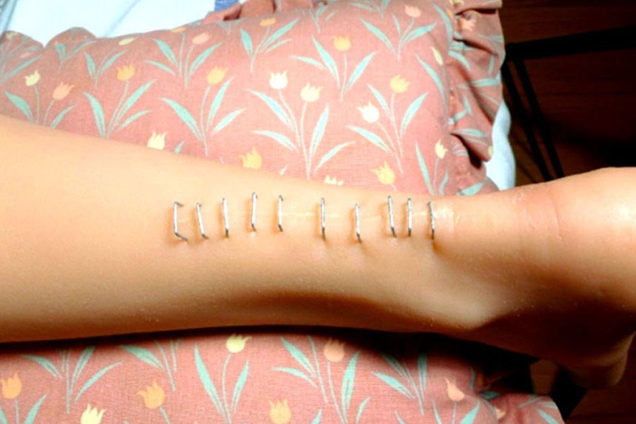 A RealDoll ankle with a line of ten staples punctured into it.